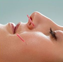 Cosmetic Acupuncture