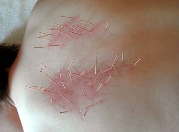 Needle Insertion during acupuncture